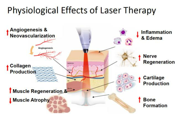 HIGH INTENSITY CLASS IV LASER THERAPY